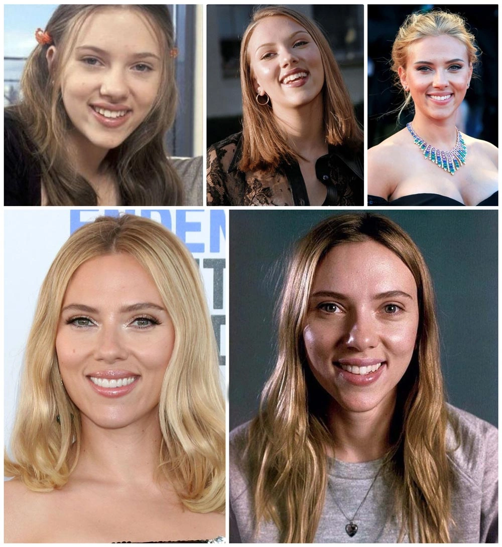 Scarlett Johansson Teeth Veneers And Smile Evolution Guide