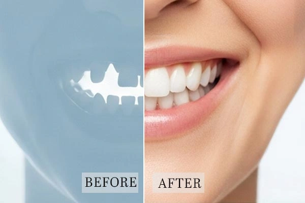 All On 4 Dental Implants Before And After Overview