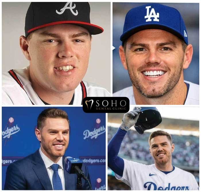 Freddie Freeman's Teeth and Veneers