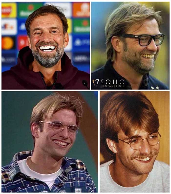 Jurgen Klopp Teeth Before and After | The $30,000 Smile Makeover