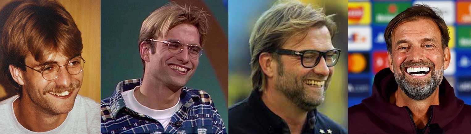 Jurgen Klopp Teeth Before and After | The $30,000 Smile Makeover