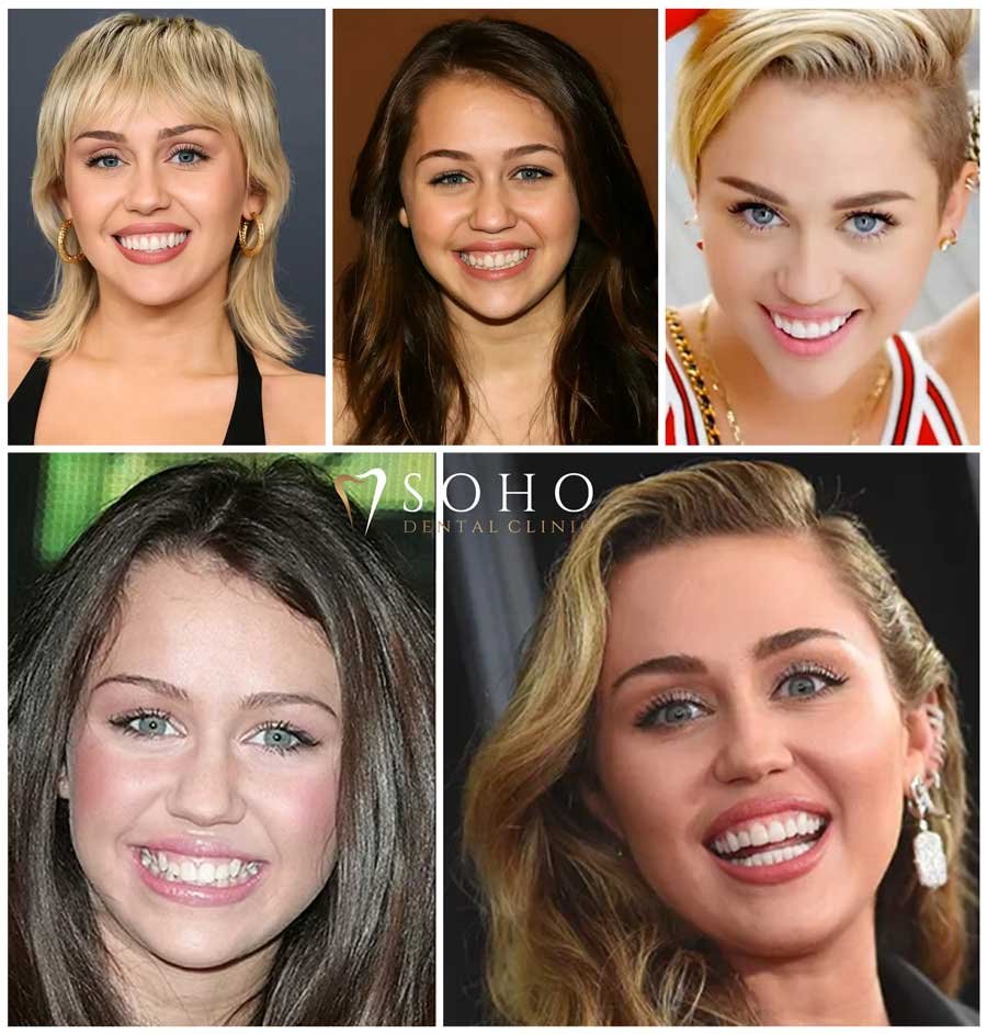 Miley Cyrus Teeth Before and After: A Hollywood Smile Journey