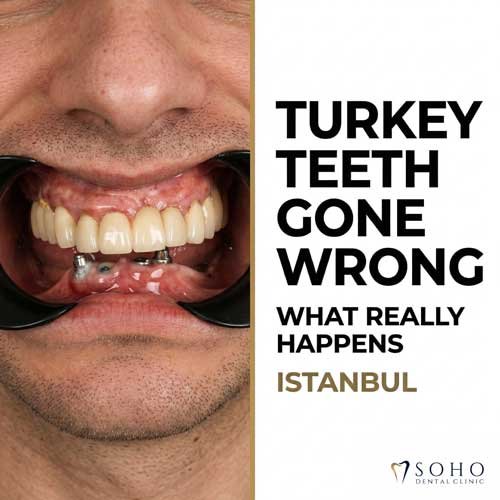 Turkey Teeth Gone Wrong What Really Happens — And How We Fix It
