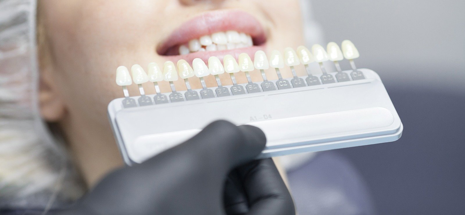 Dental Veneers in Istanbul, Turkey