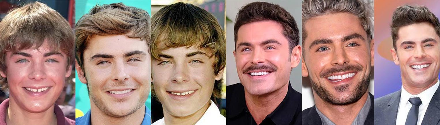 Zac Efron Veneers The Truth Behind His Smile Transformation