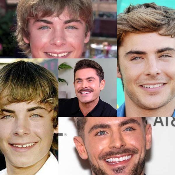 Zac Efron Veneers The Truth Behind His Smile Transformation