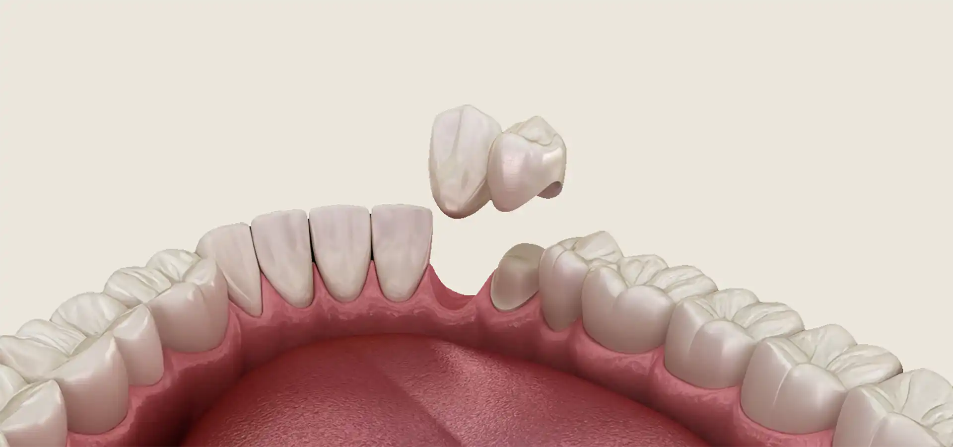 Cantilever Dental Bridges in Istanbul, Turkey