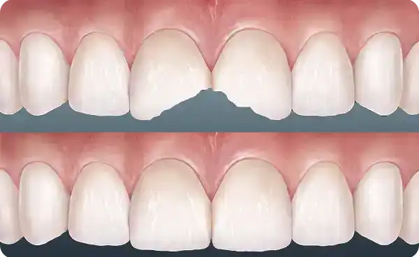 Composite Bonding