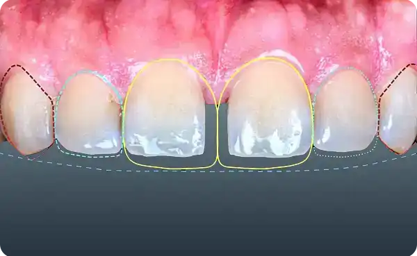 Diastema Closure
