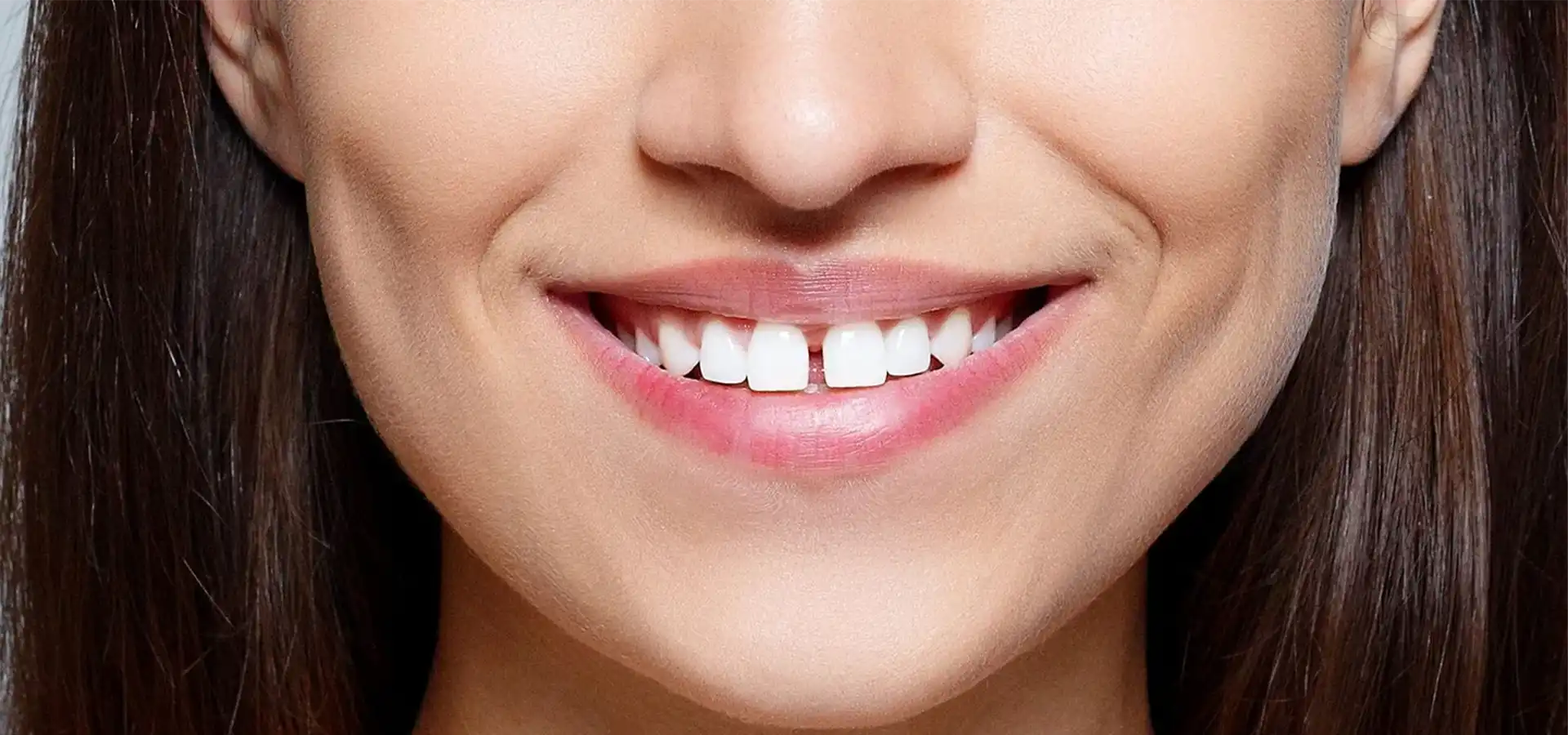 Diastema Closure in Istanbul, Turkey