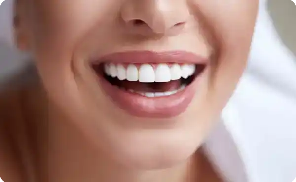 E-max Crowns
