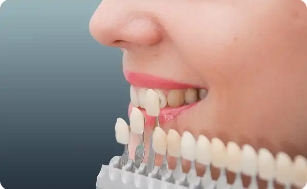 Empress Veneers