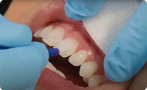 Fluoride Treatment