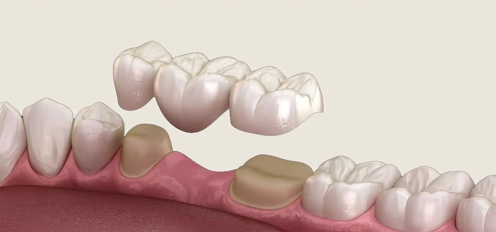 Full Ceramic Crowns in Istanbul, Turkey