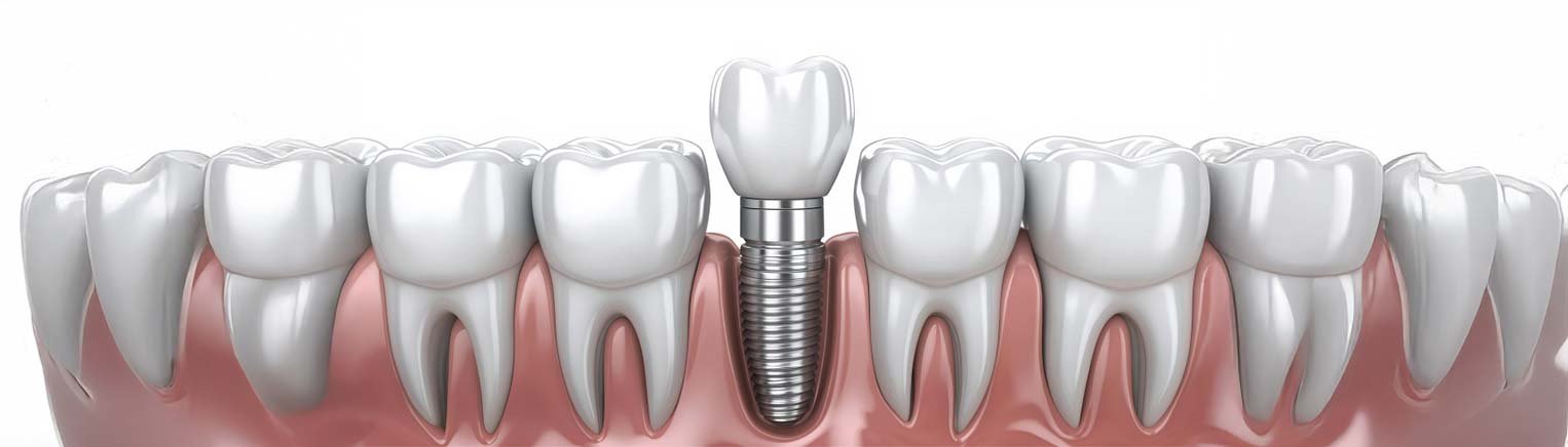 Full Mouth Dental Implants Turkey Price