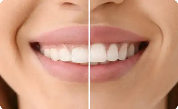 Gummy Smile Treatment