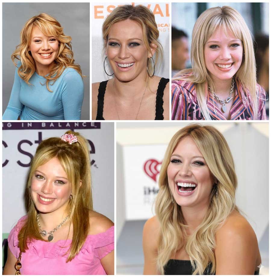 Hilary Duff Veneers Before and After: A Hollywood Smile Transformation
