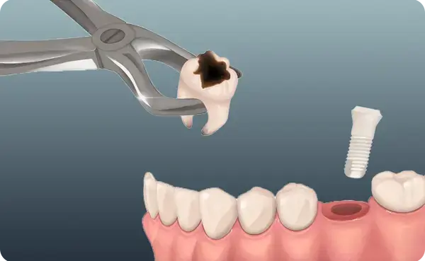 Immediate Implant Treatment