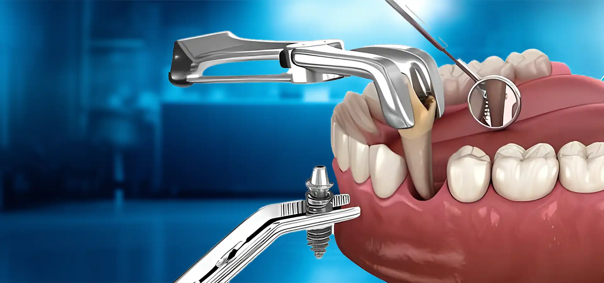 Immediate Implant Treatment in Istanbul, Turkey