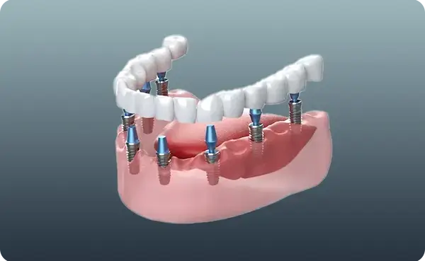 Implant Supported Dentures