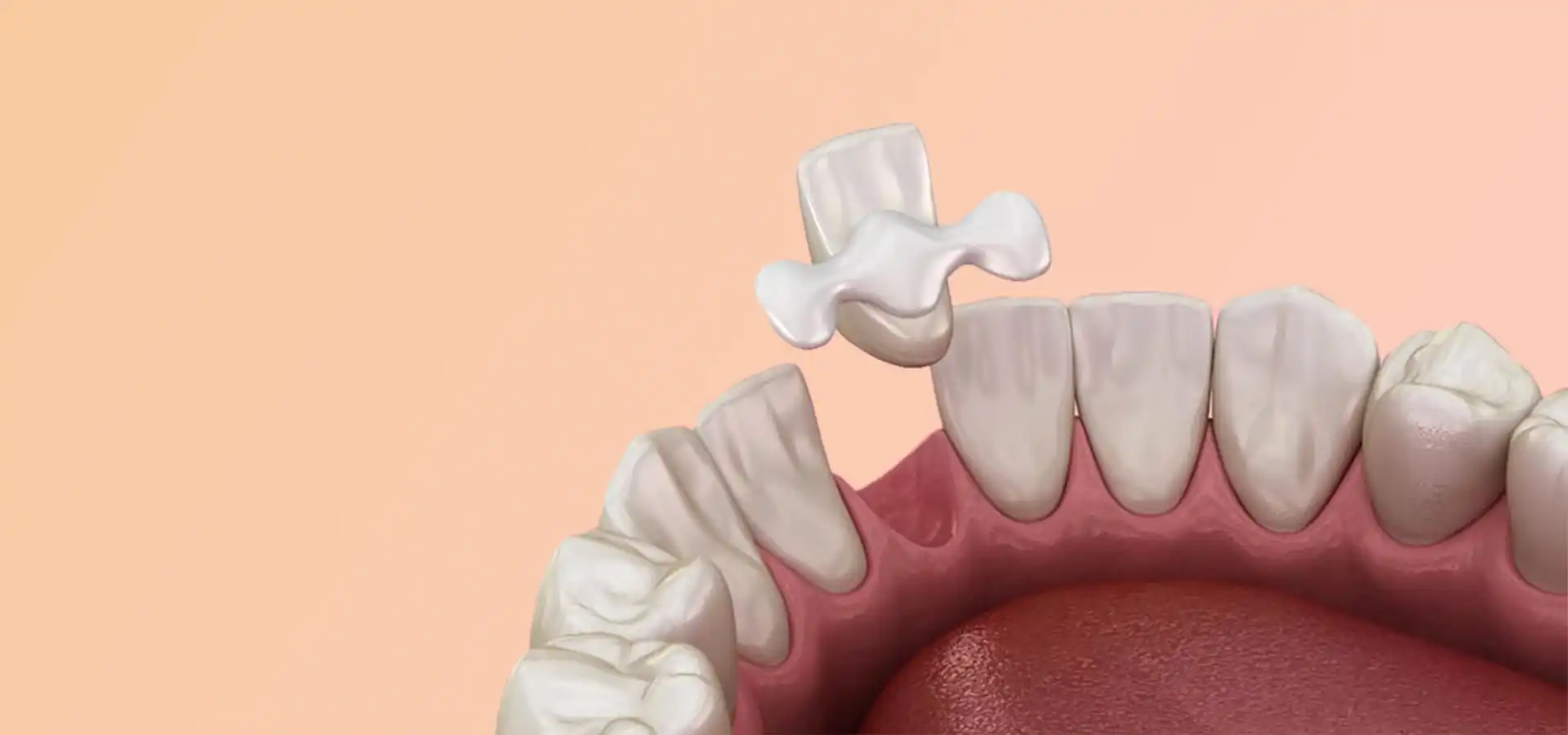 Maryland Dental Bridges in Istanbul, Turkey