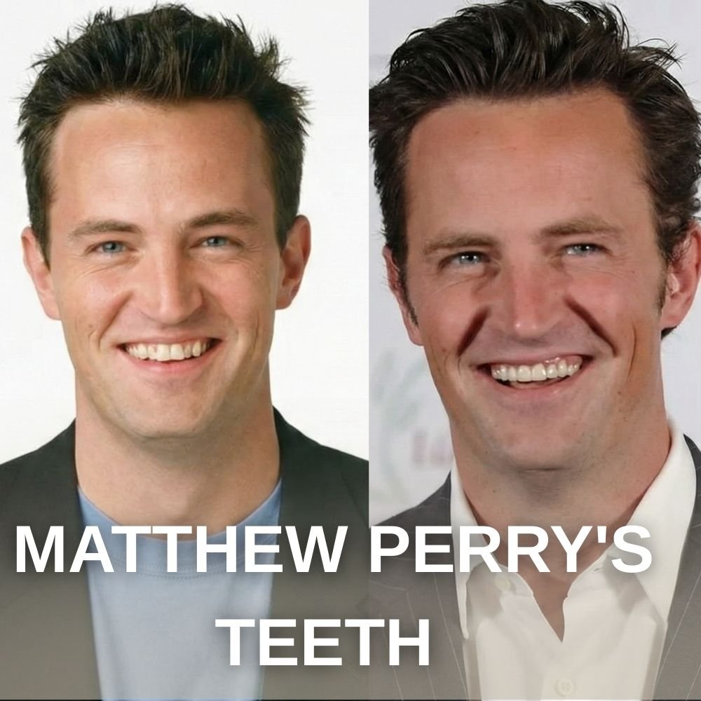 Matthew Perry's Teeth Transformation