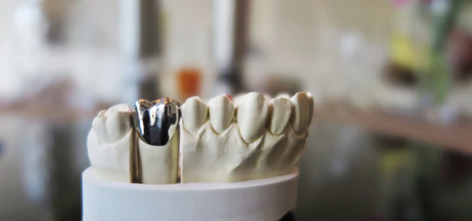 Metal Porcelain Crowns (PFM) in Istanbul, Turkey