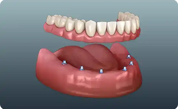 Overdenture