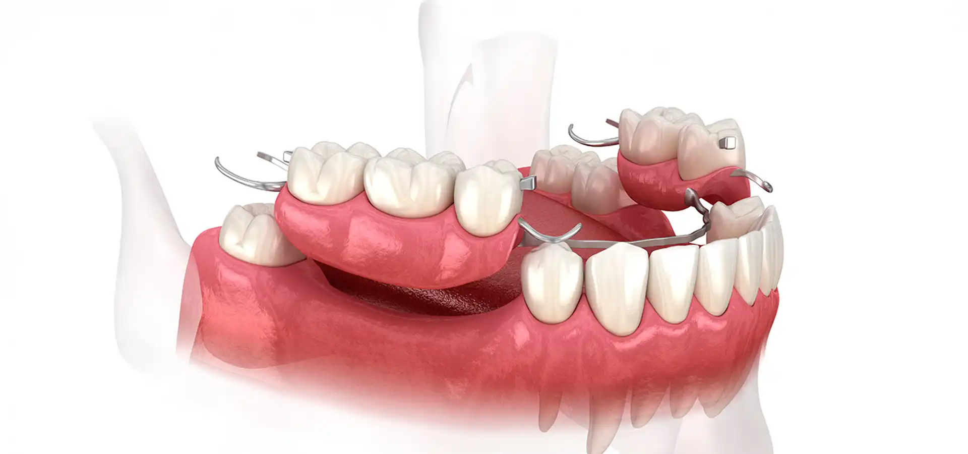 Partial Dentures in Istanbul, Turkey