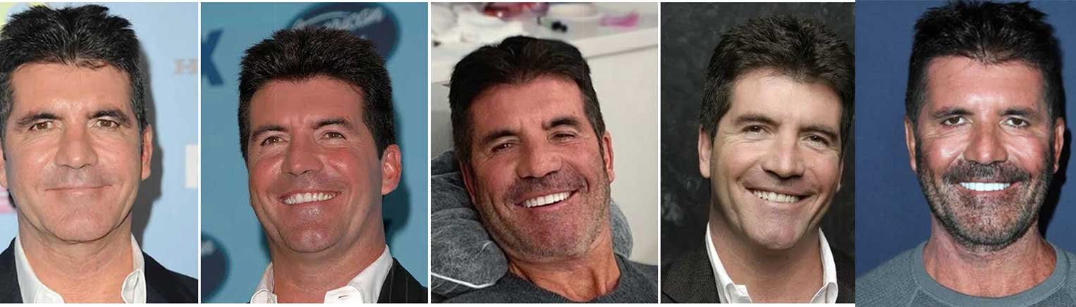Simon Cowell Teeth Before and After What Really Happened to His Smile