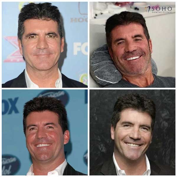 Simon Cowell Teeth Before and After What Really Happened to His Smile