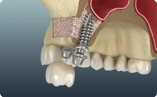 Sinus Lifting
