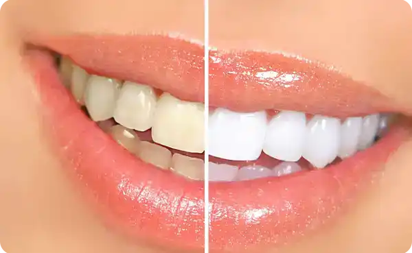Teeth Whitening