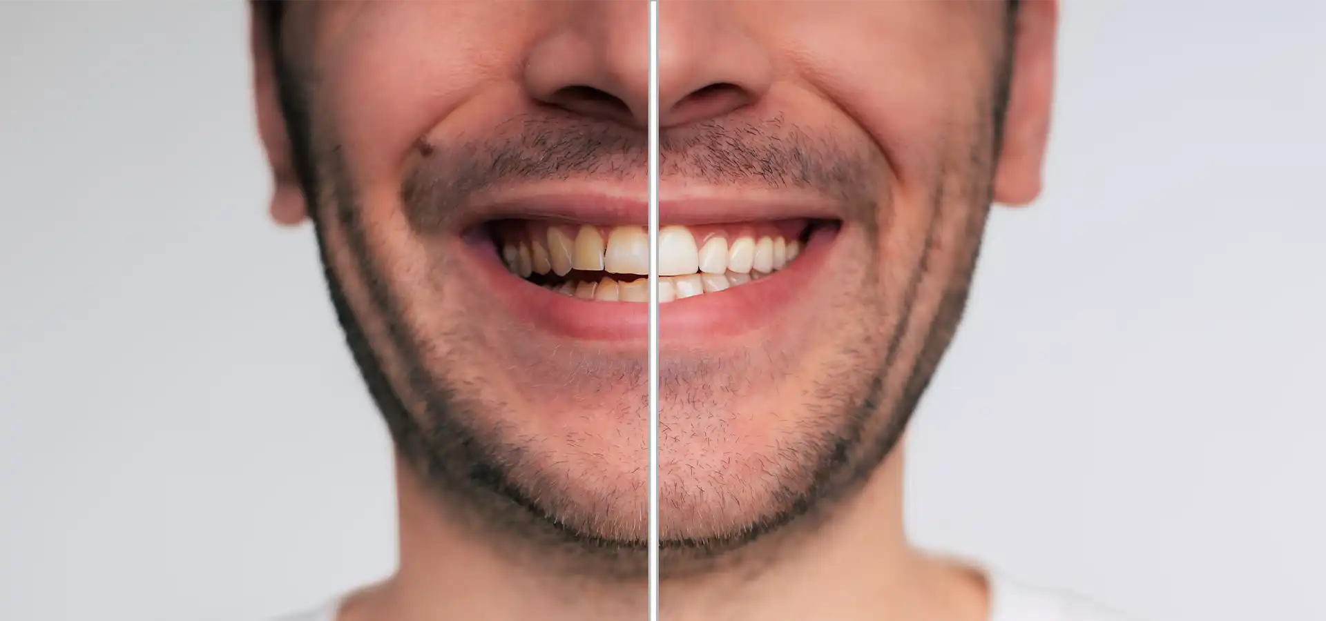 Teeth Whitening in Istanbul, Turkey