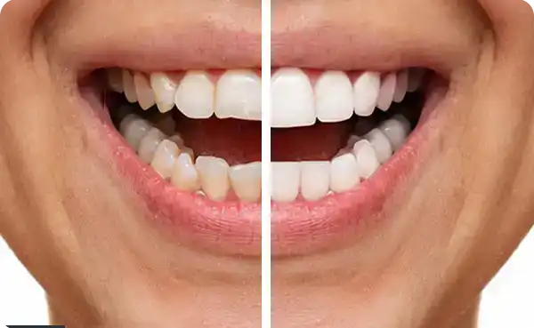 Tooth Contouring & Shaping