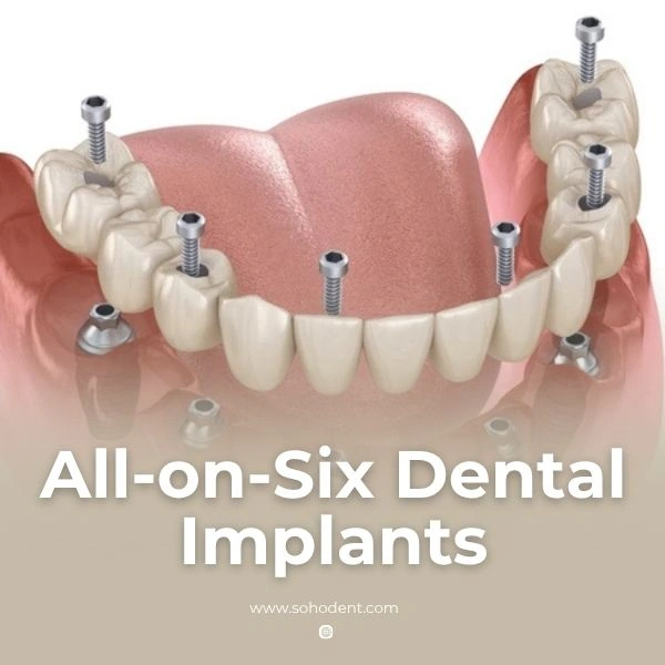 All-on-6 Dental Implants in Turkey