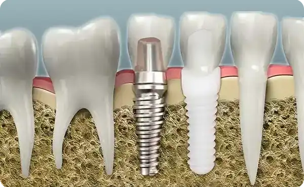 Zirconium Implants