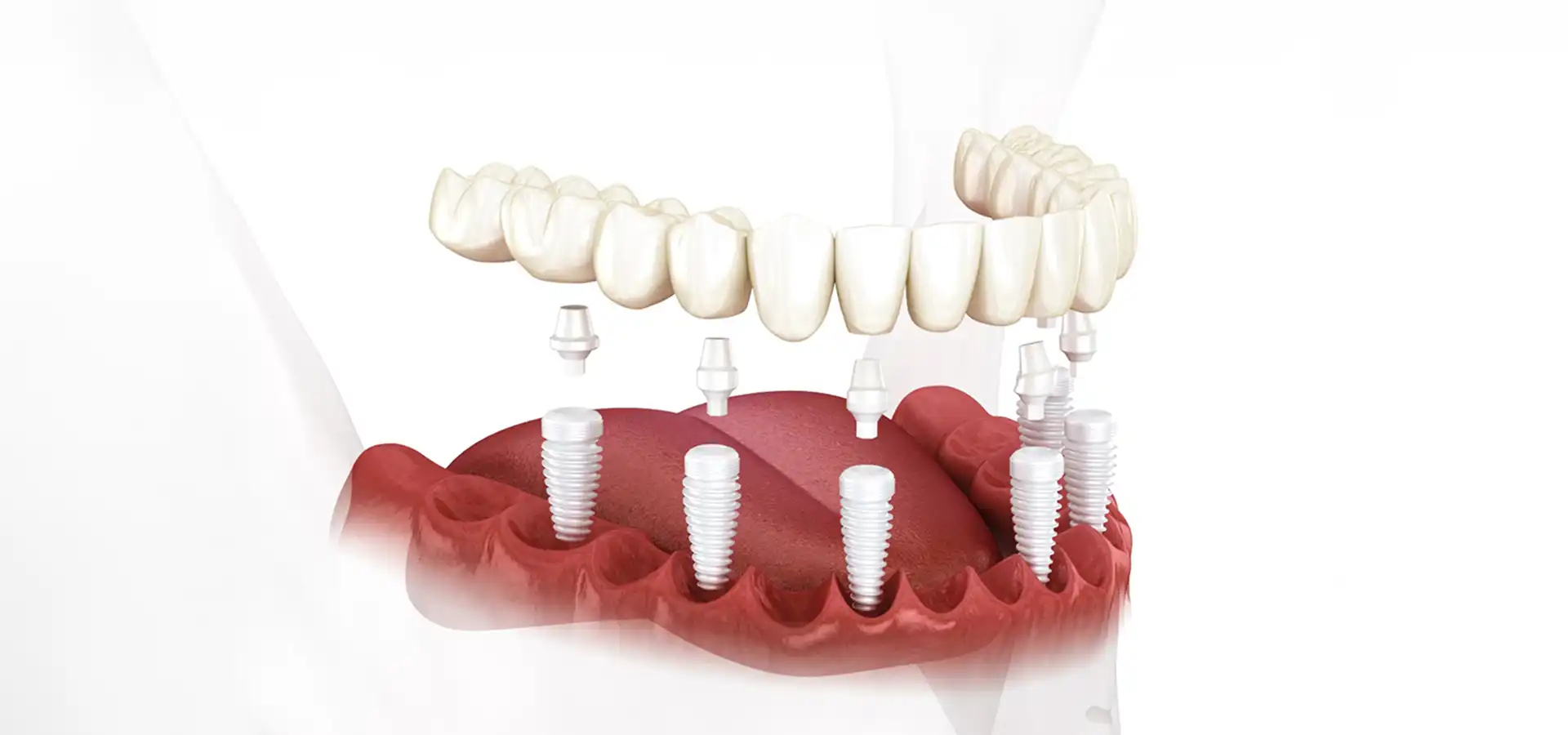 Zirconium Implants