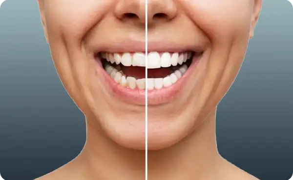Zirconium Veneers