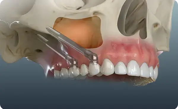 Zygomatic Implants