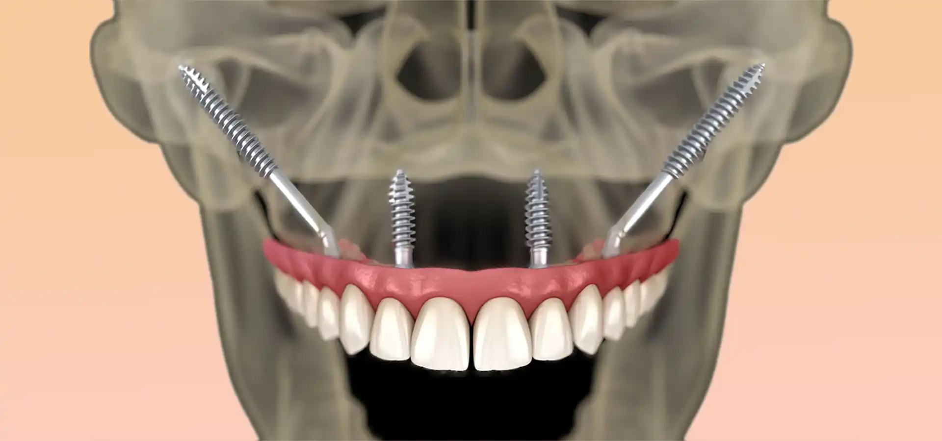 Zygomatic Dental Implants in Istanbul, Turkey