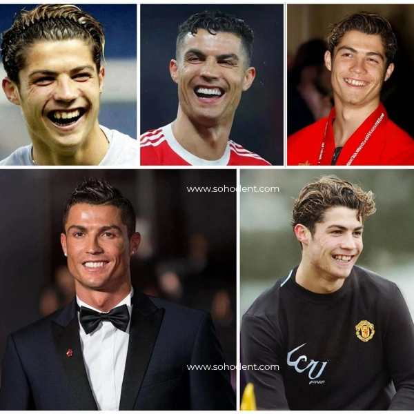 Cristiano Ronaldo Teeth Before And After Veneers