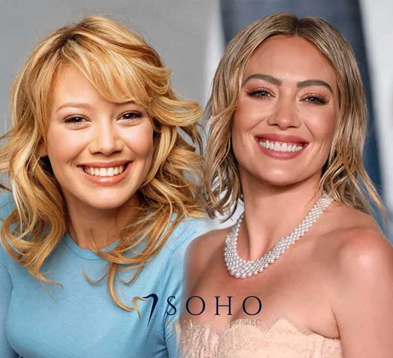 HILARY DUFF BAD VENEERS