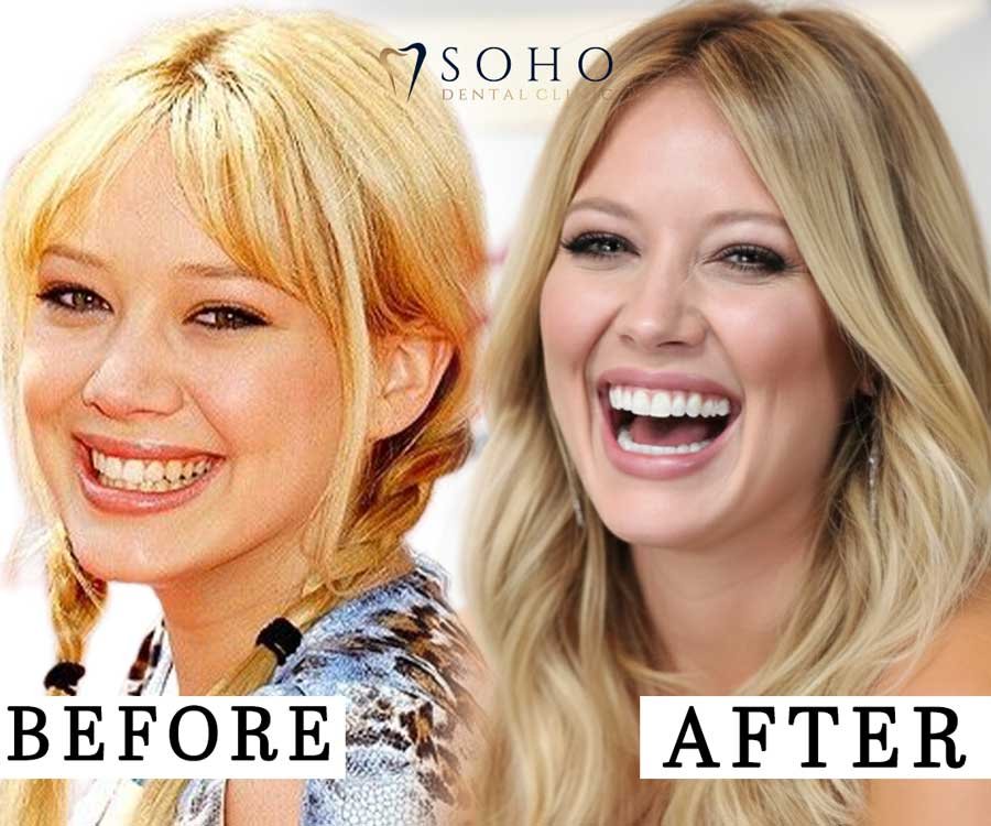 Hilary Duff Veneers Before and After: A Hollywood Smile Transformation