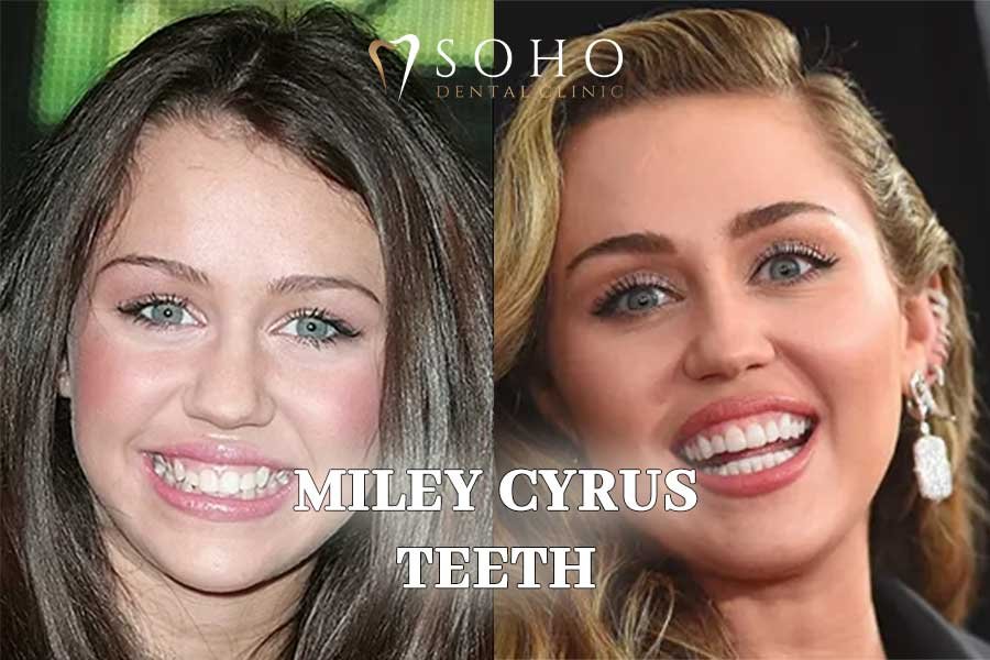 miley cyrus 4 teeth