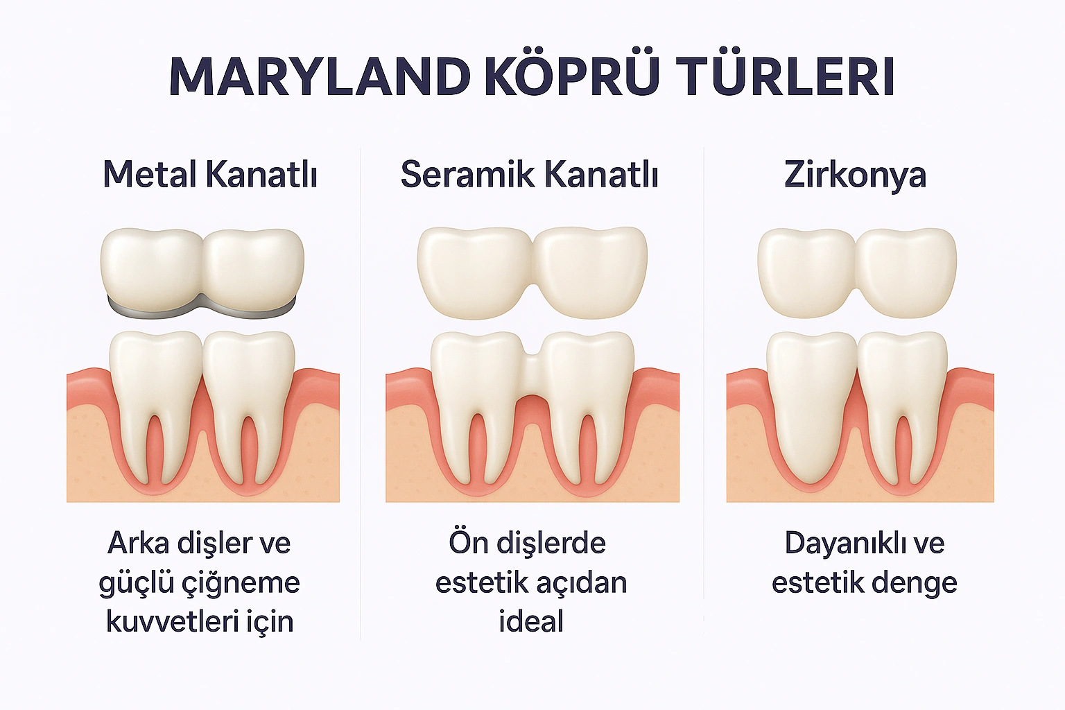 maryland köprü türleri