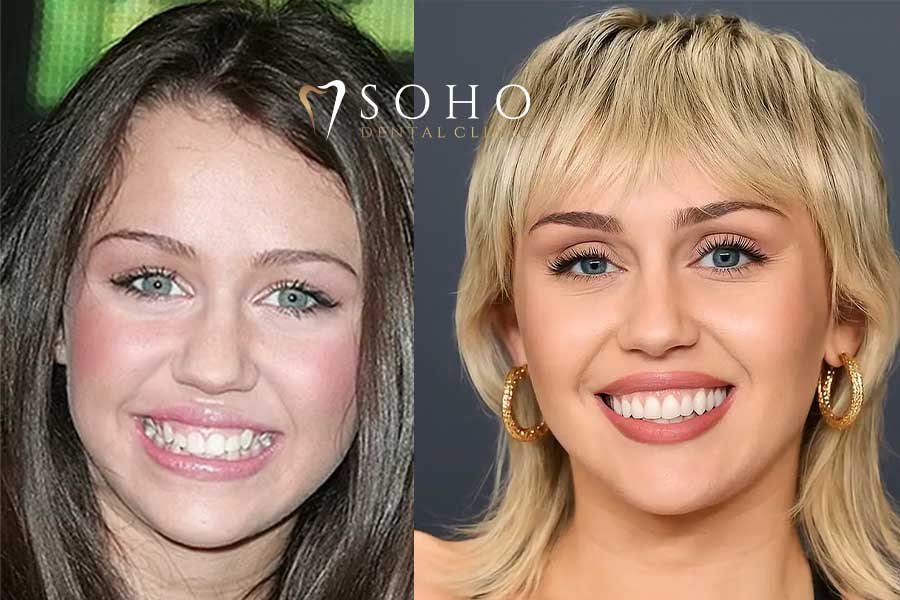Analyzing the "Before": What Were Miley's Teeth Like?