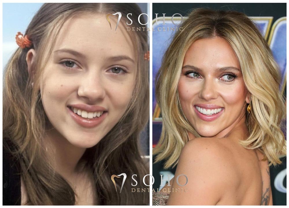 Scarlett Johansson’s teeth veeners price