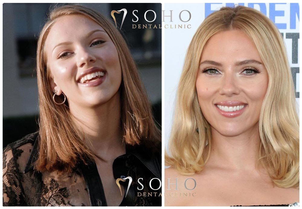 Scarlett Johansson’s teeth veeners
