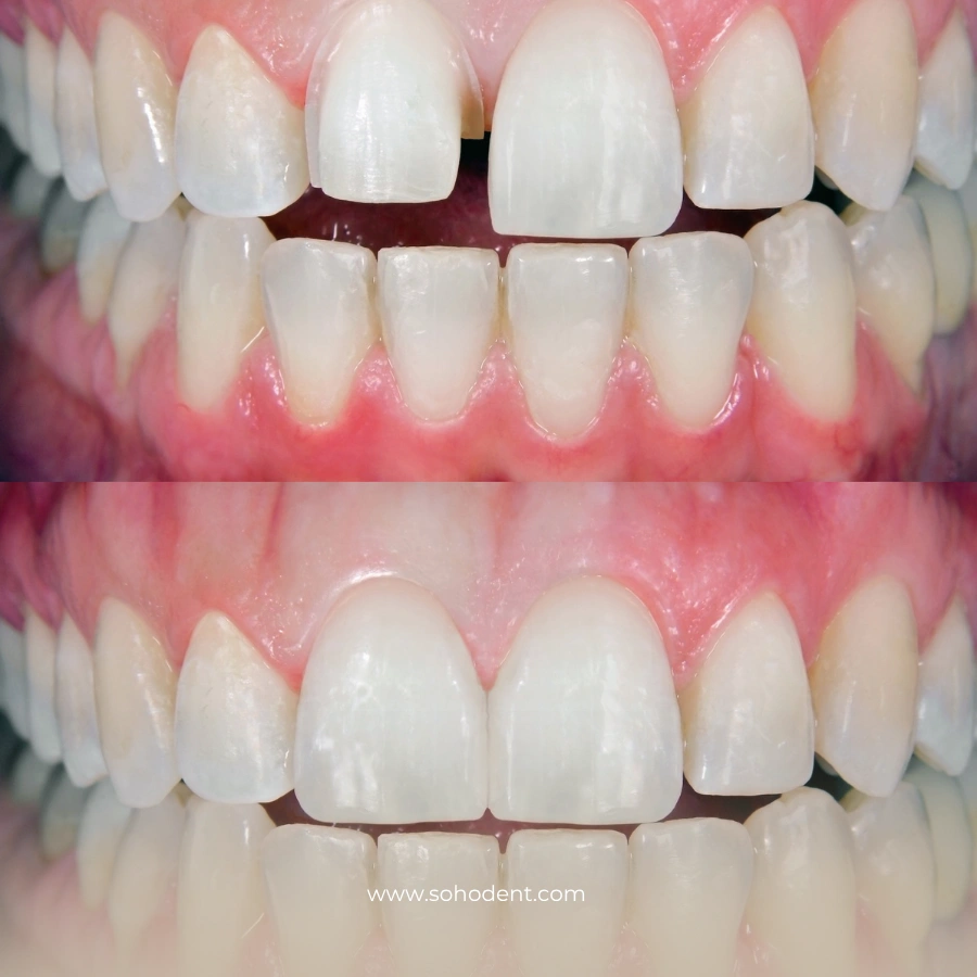 Tam Seramik Kaplamanın Avantajları